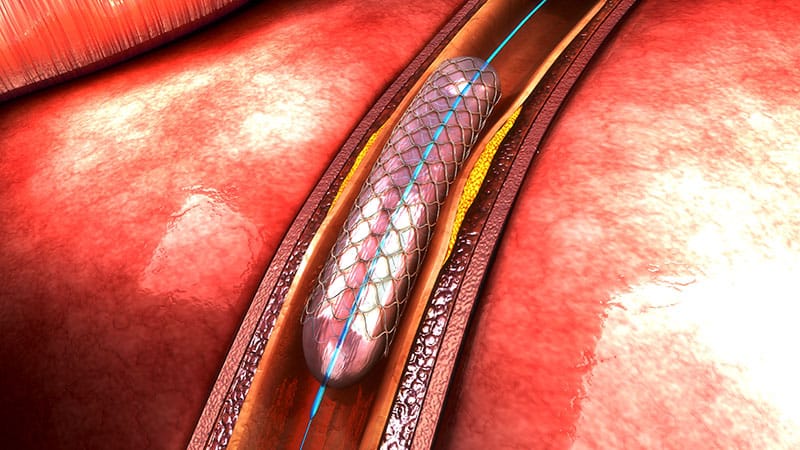 Functional Angio Wins in Multivessel STEMI