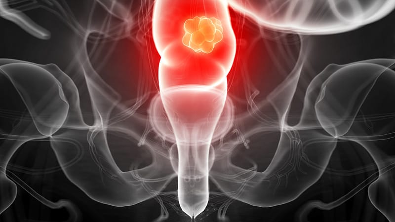 NCI Task Force Issues Rectal Cancer Trial Design Recs - Vimarsana News