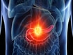 photo of pancreas cancer