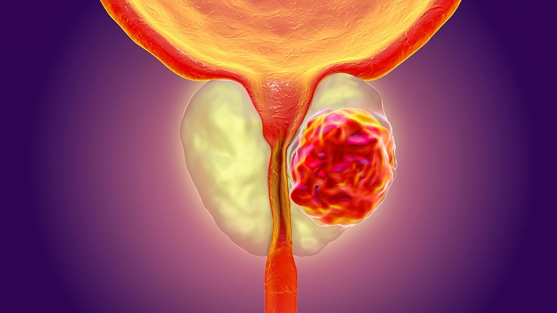La RT à dose plus élevée prolonge la survie dans le cancer de la prostate à haut risque