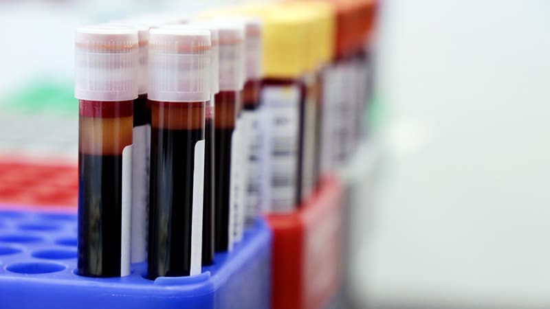 Une étude révèle des disparités dans les tendances en matière de tests de biomarqueurs CRC
