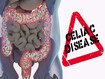 photo of Gut microbiome and celiac disease