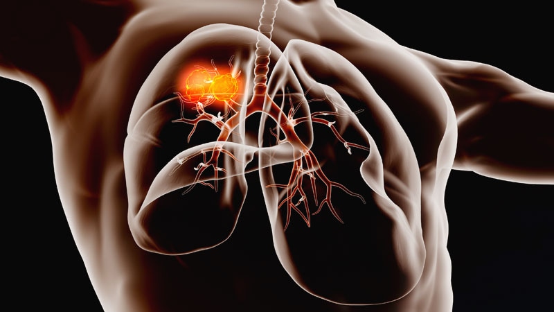 Nivolumab Plus Chemotherapy Improves Survival in Lung Cancer