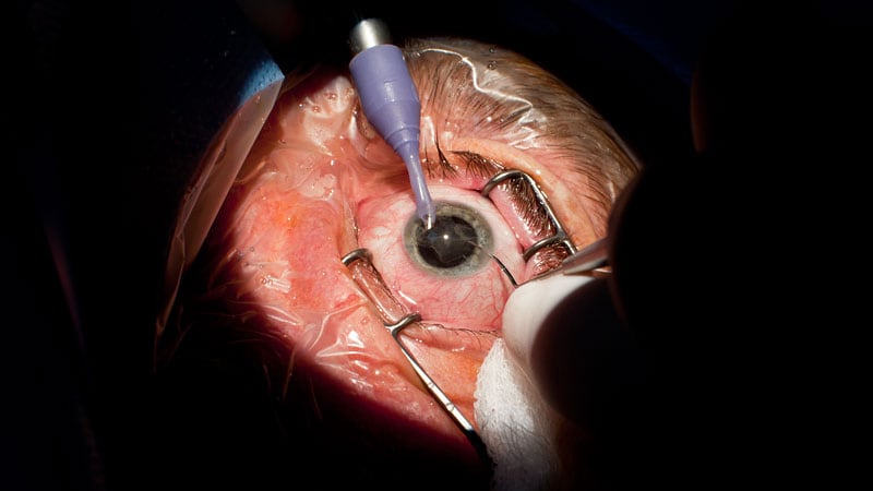 Cataract Surgery May Be Safe Beyond A1c Cutoffs
