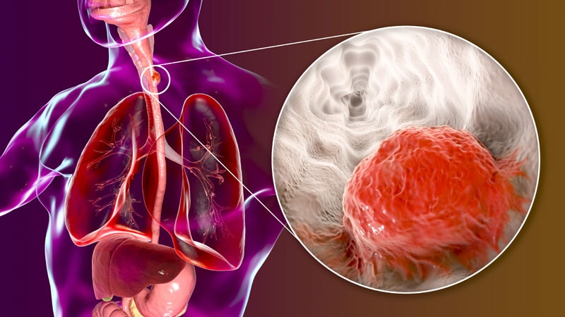 Immunotherapy + CRT Boosts Response in Esophageal Most cancers