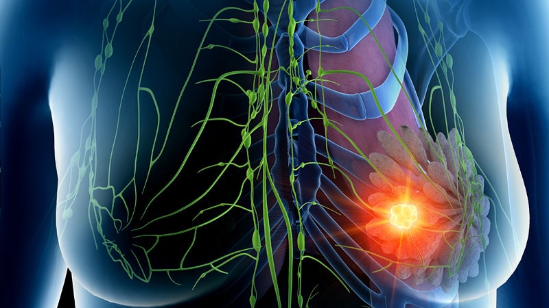 Skipping Axillary Lymph Node Dissection in Breast Cancer?