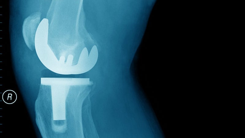 Arthroscopy Doesn't Delay Total Knee Replacement in OA