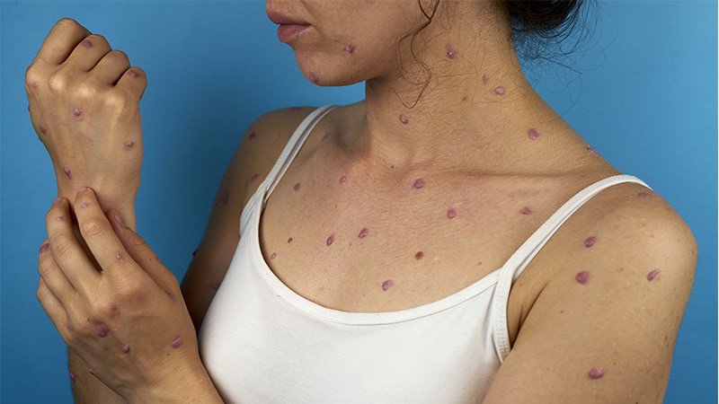 Growing Mpox Outbreak Prompts CDC Health Advisory
