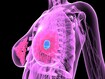photo of Breast cancer illustration
