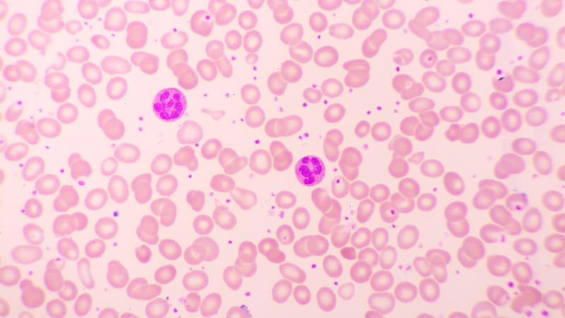 NICE Recommends Avatrombopag for Chronic Immune Thrombocytopenia