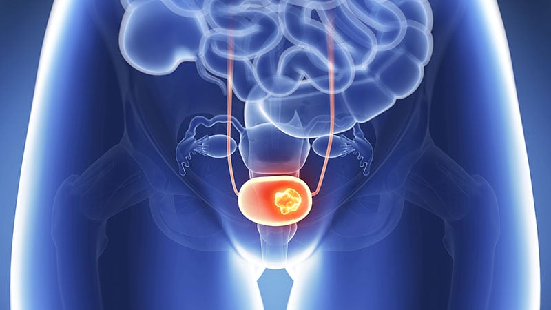 Trimodal Therapy Costs Offset QOL Benefit in Bladder Cancer