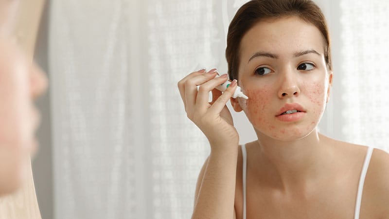 Dermatologists Wary of AI-Directed Acne Prescribing in Utah