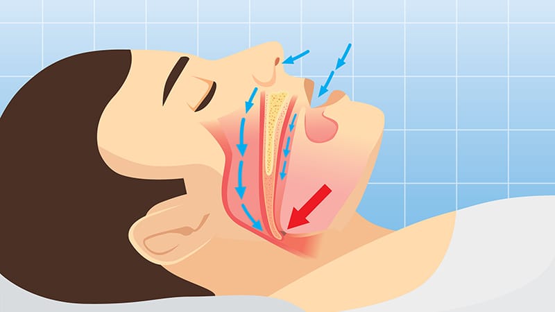 Watchful Waiting vs. Surgery for Mild to Moderate Pediatric Sleep Apnea