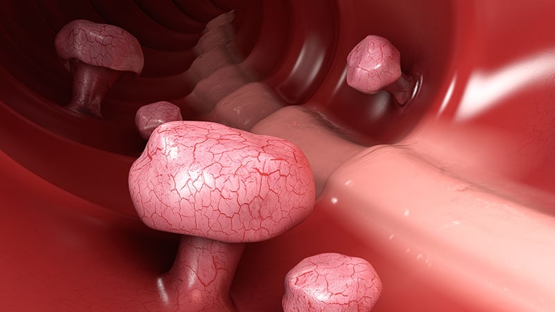 Bowel Prep Quality Affects Long-Term Colonoscopy Outcomes