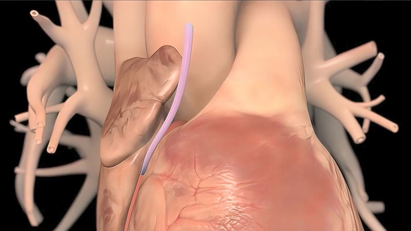 Minimally Invasive CABG Yields Faster Functional Recovery