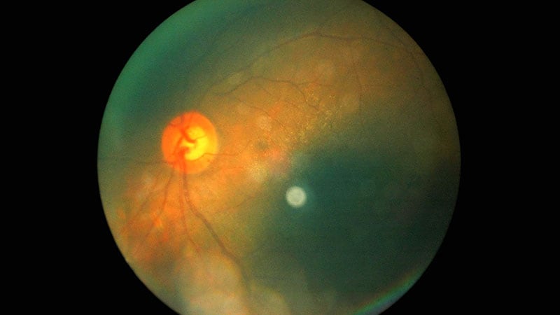 Early Eye Exams Are Essential for New Patients With Diabetes