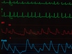 photo of Monitor with Atrial Fibrillation