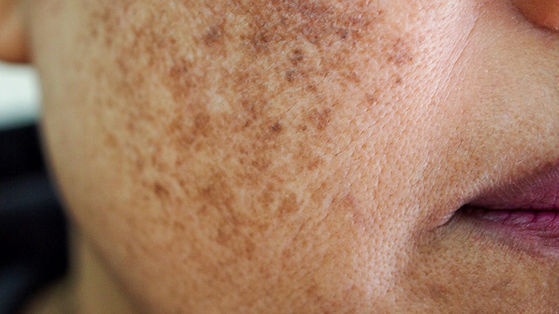 Center Views Melasma ‘Through A New Lens,’ Founder Says