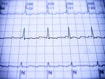 photo of Atrial Fibrillation ecg