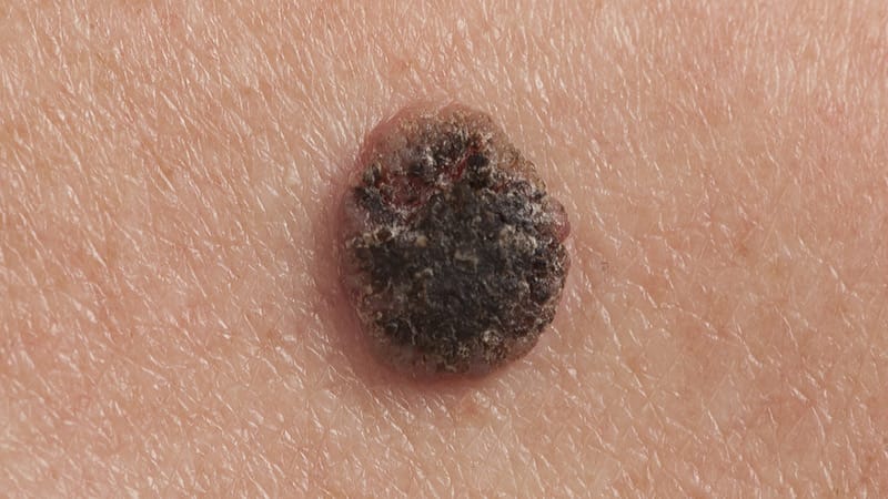 Mohs Shows Superior Outcomes in Squamous Cell Skin Cancer