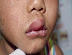 photo of Angioedema at lips of Asian male child