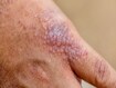 photo of atopic dermatitis on hand