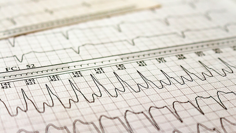 AF Ablation Works…But: SHAM PVI