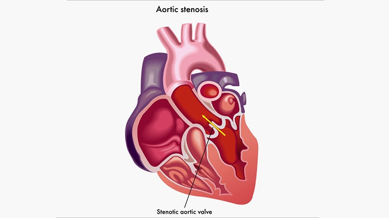 L’échographie non invasive profite aux valvules aortiques calcifiées