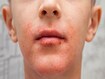 photo of Teen boy suffering from atopic dermatitis