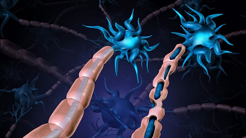 photo of multiple sclerosis