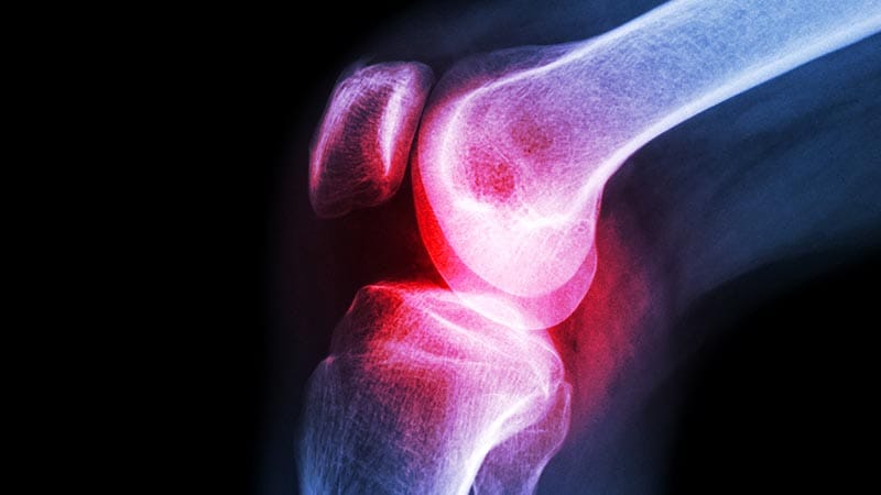 La diacéréine, le resvératrol et la toxine botulique déçoivent dans l’arthrose du genou
