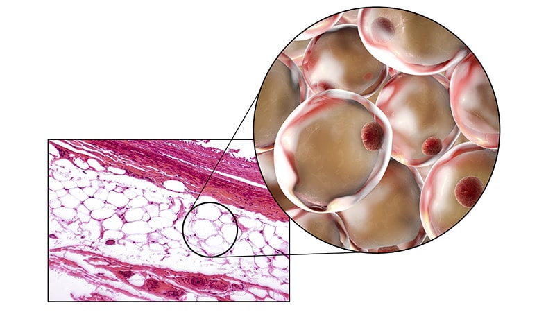 Inflammation and Obesity: Which Starts the Cycle?