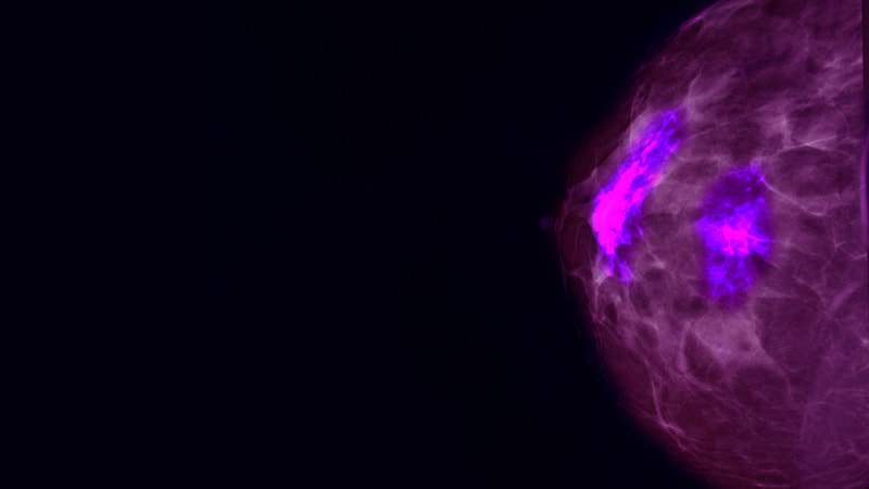 Nouveaux essais sur le cancer du sein : votre patiente pourrait-elle en bénéficier ?