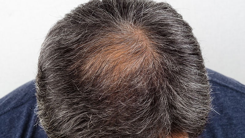 Atypical CCCA Hair Loss Remains Underappreciated