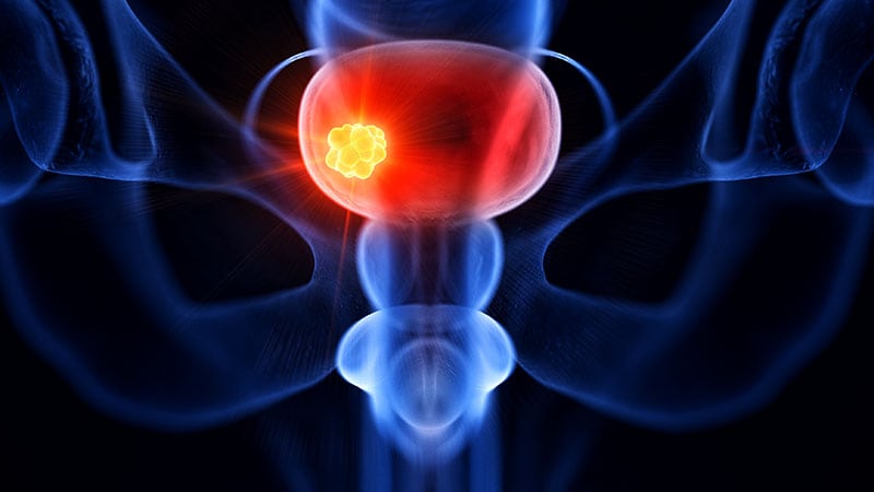 Bladder Cancer 