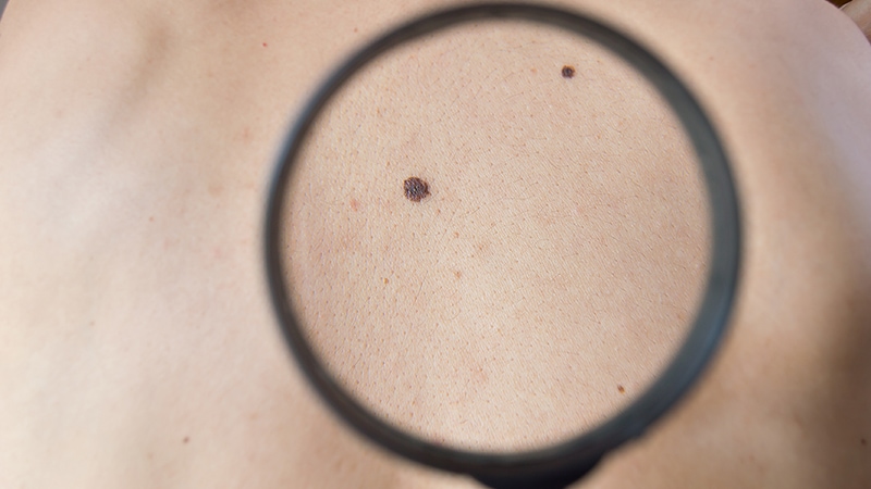 Melanoma Mortality Rises at 0.8-mm Thickness, Examine Finds