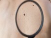 photo of melanoma