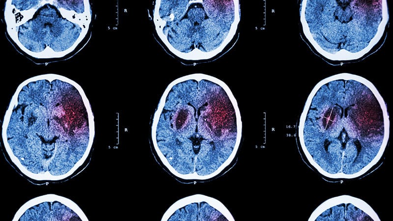 Stroke Incidence Higher Among Indigenous People - Vimarsana News