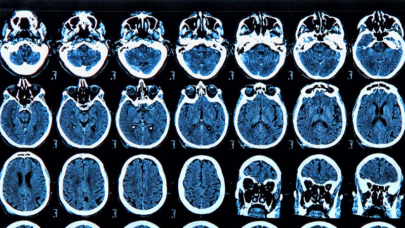 Moderate to Severe TBI Linked to Brain Cancer Risk