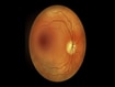 photo of Diabetic macular edema