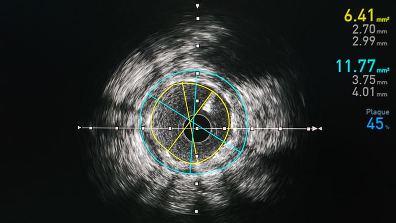 IVUS Bests Angiography to Guide PCI in ACS