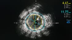 Unexpected Results Lead to Questions on IVUS-Guided PCI