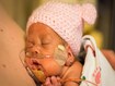 photo of premature baby