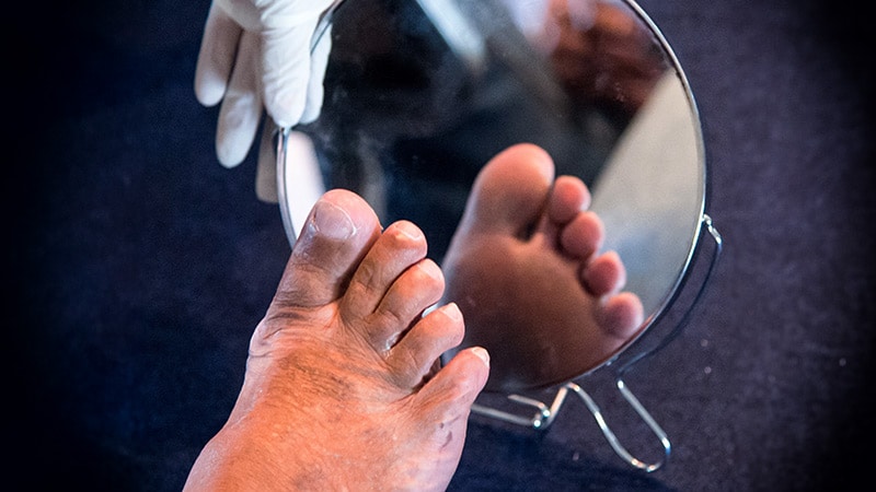 Diabetic Foot Infections: A Peptide's Potential Promise