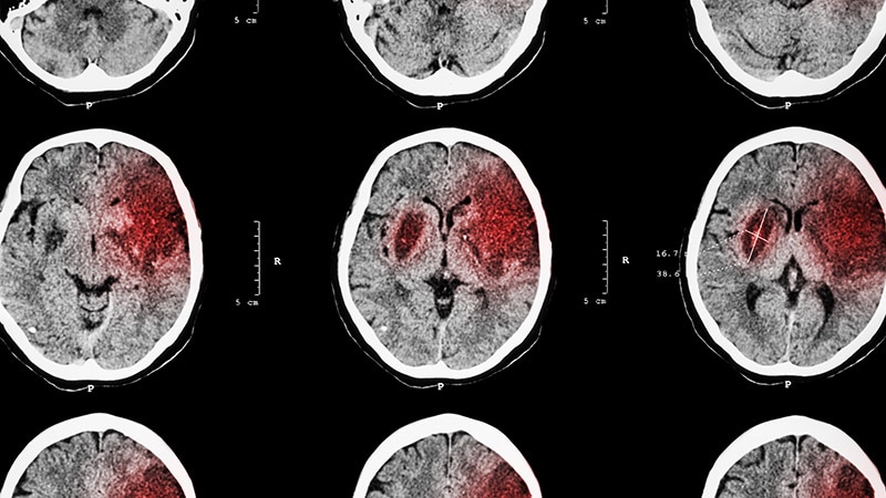 Reteplase Superior to Alteplase in Chinese Stroke Trial