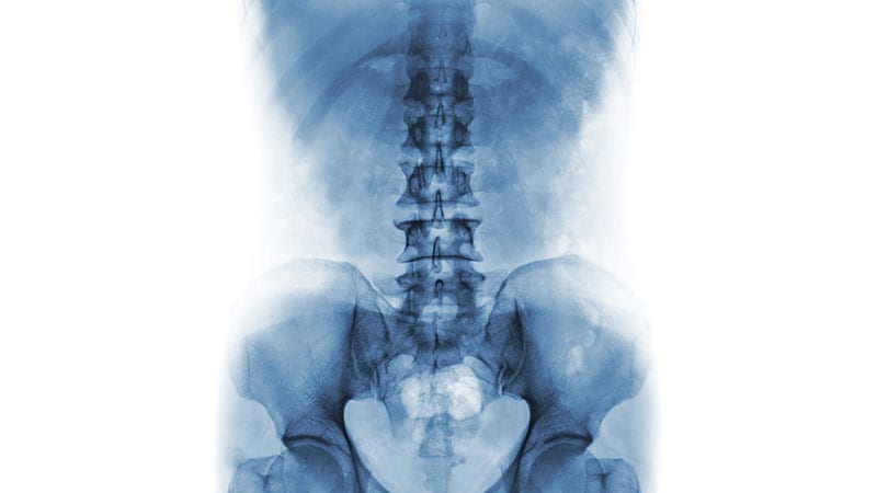 Axial Involvement in PsA Still Defies Definition