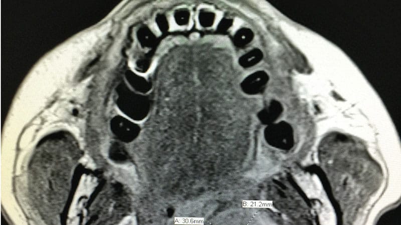 Is MRI Better at Finding Early Nasopharyngeal Cancer?
