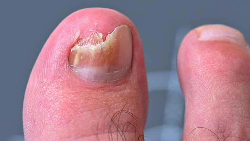 Imaging Technique Reveals Key Features of Nail Diseases