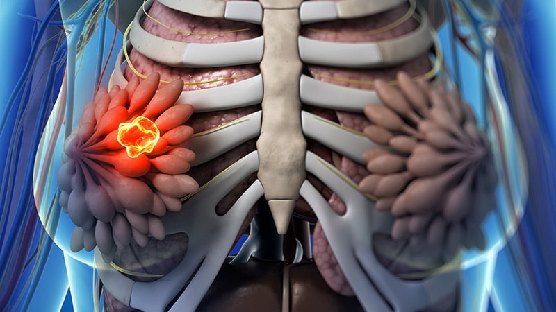 Hypofractionated RT Noninferior for Locoregional BC