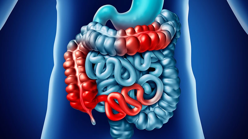 In Crohn's Disease, Early Anti-TNF Levels May Be Crucial thumbnail